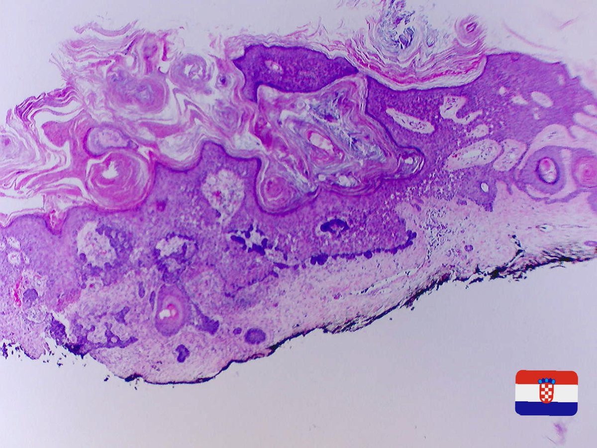 Dr_Jukic's tweet photo. Happy New Year, here's a case for you. Two low power images only, give me your diagnosis. #dermpath #dermatology #pathology https://t.co/bPTw08f5dv