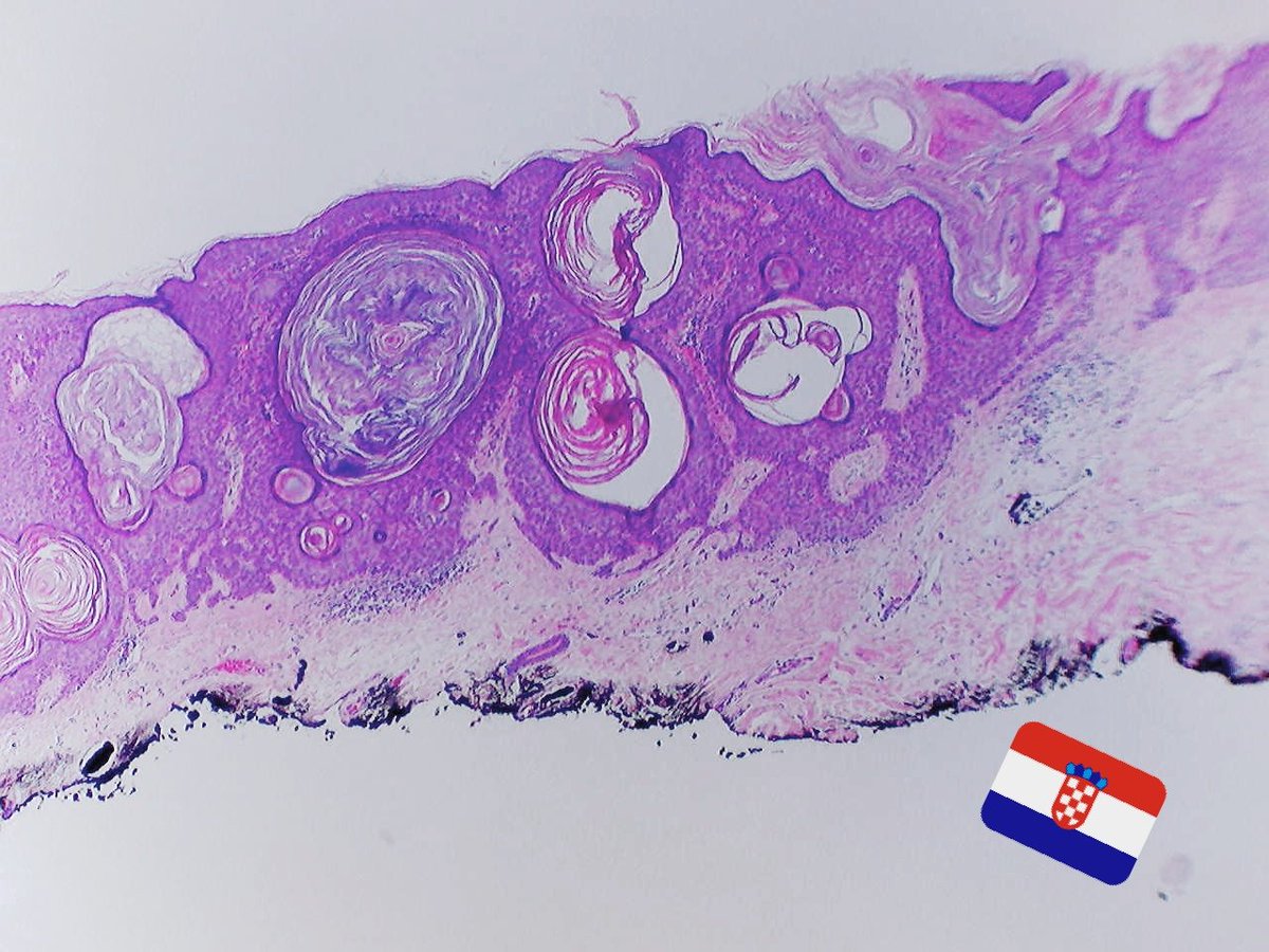 Dr_Jukic's tweet photo. Happy New Year, here's a case for you. Two low power images only, give me your diagnosis. #dermpath #dermatology #pathology https://t.co/bPTw08f5dv