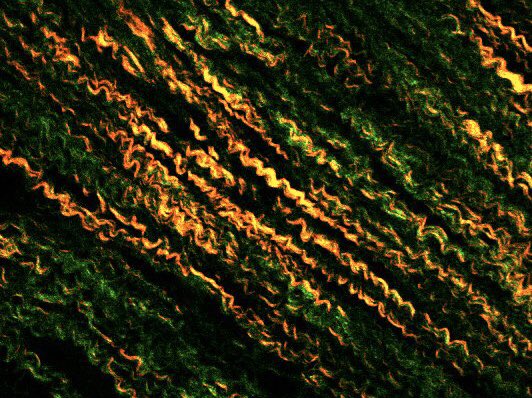 James Chong (@jameschong_doc) on Twitter photo 2/2) Can we make #betterscar after heart attack? Our paper in Science Transl Med shows how. Image: more aligned collagen in rhPDGF treated hearts after myocardial infarction <a href="/ScienceTM/">Science Translational Medicine</a> <a href="/AusStemCell/">Stem Cell Foundation</a> <a href="/StemCellsAus/">Stem Cells Australia</a> <a href="/sujitha_thava/">Sujitha Thavapalachandran</a> <a href="/AnastasiaSMihai/">Dr Anastasia Mihailidou FAHA FCSANZ FESC</a> <a href="/OzCvA/">ACvA</a> @CSHeartResearch <a href="/clara_chow/">Clara Chow</a> 2/2) Can we make #betterscar after heart attack? Our paper in Science Transl Med shows how. Image: more aligned collagen in rhPDGF treated hearts after myocardial infarction <a href="/ScienceTM/">Science Translational Medicine</a> <a href="/AusStemCell/">Stem Cell Foundation</a> <a href="/StemCellsAus/">Stem Cells Australia</a> <a href="/sujitha_thava/">Sujitha Thavapalachandran</a> <a href="/AnastasiaSMihai/">Dr Anastasia Mihailidou FAHA FCSANZ FESC</a> <a href="/OzCvA/">ACvA</a> @CSHeartResearch <a href="/clara_chow/">Clara Chow</a>