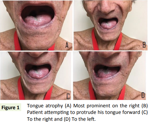 medclinrev's tweet photo. An Undulating Tongue: Post-#Irradiation #Myokymia and #Neuromyotonia of the Tongue Following #Radiation #Therapy for #Tonsillar #Cancer
Know more: https://t.co/YPJio5NcQe https://t.co/6McaVYeQ8K