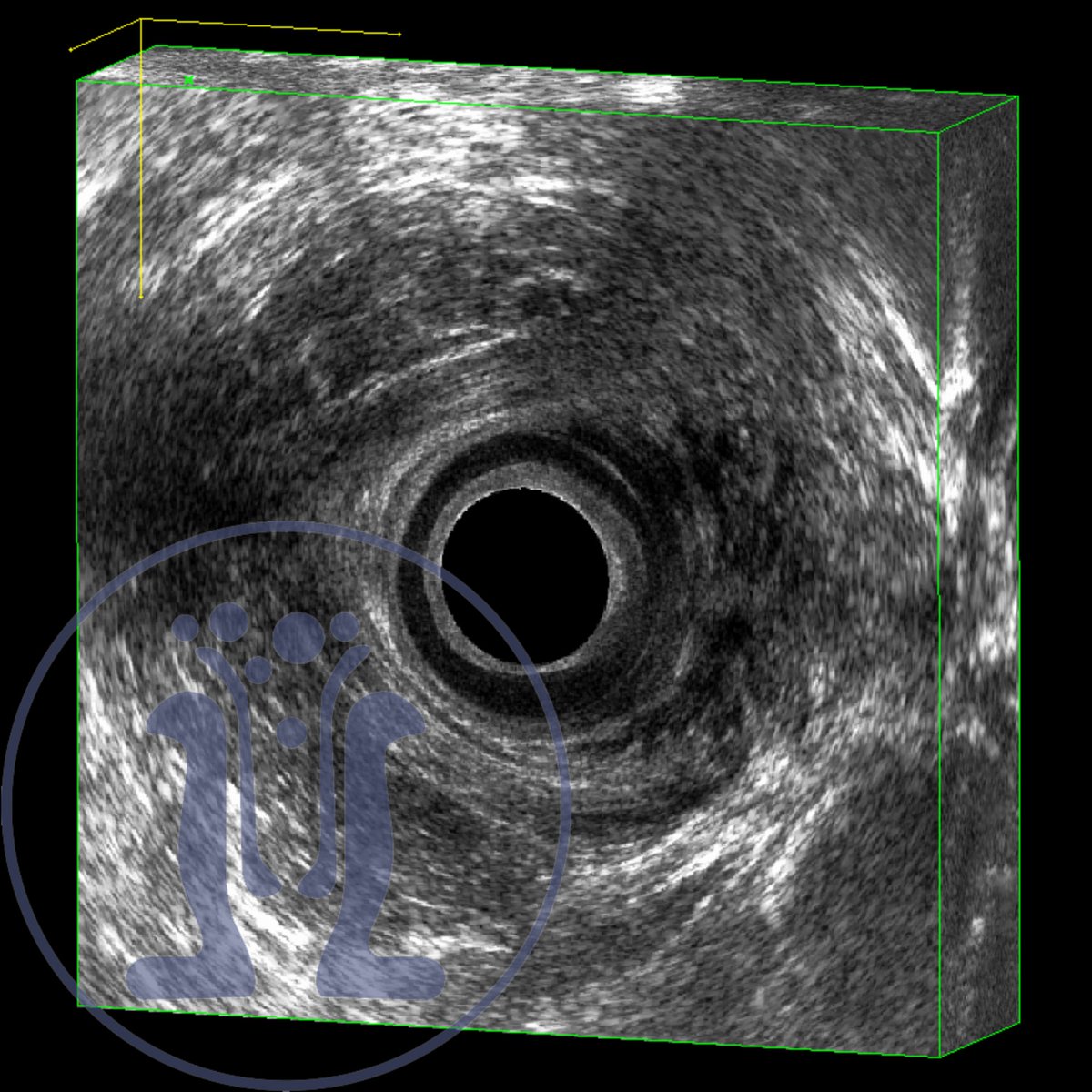 Τα χαμηλά συρίγγια που διαπερνούν μικρό ή καθόλου τμήμα του σημαντικού έξω σφιγκτήρα συνήθως αντιμετωπίζονται επαρκώς στο ιατρείο με τοπική αναισθησία. Έτσι, αποφεύγεται η γενική αναισθησία, το μεγάλο στρες και το αυξημένο κόστος ενός χειρουργείου. 
proctology.gr/%cf%87%cf%87-0…