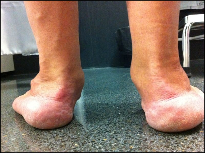 MgJenrique's tweet photo. Disfunción del Tibial Posterior: Causa más frecuente del Pie Plano Adquirido del Adulto. Se produce: Colapso del arco interno, valgo de retropié, Abducción antepié e inclinación vertical del astrágalo. Deformidad en varios planos que no es fácil abordar. https://t.co/z5PnHeYTWC