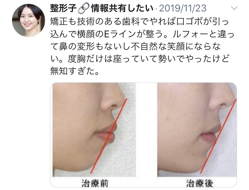 私のパクツイ繰り返すのも不愉快だけど、してもない手術歴プルフィールに書いて体験者のように装ってるのが許せない。訂正すると私がTwitter始めた頃がDT鬱真っ只中だったから、手術に対する鬱ツイートしてたけど今は改善してる。骨治さないと治らないからDT大変だけど今は手術選んだこと後悔してない https://t.co/2gqItBEXGt