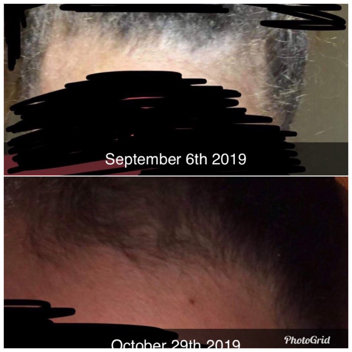 JandDsCreations's tweet photo. ‼️‼️‼️REAL RESULTS ‼️‼️‼️
100% all natural hair growth products at an affordable price 😍😍❤️ shop @JandDsCreations edge growth serum which is only $5 ‼️ Real results from real people ☺️💁🏽‍♀️ shop J&amp;D’s Creations to restore those hair follicles 😍 you won’t regret it!! ❤️ https://t.co/jqCKrcrJPA
