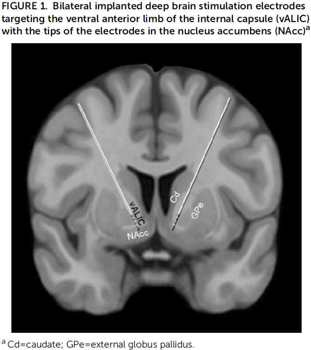 Bilateral implanted deep brain stimulation electrodes targeting the ventral anterior limb of the internal capsule (vALIC) with the tips of the electrodes in the nucleus accumbens (NAcc)