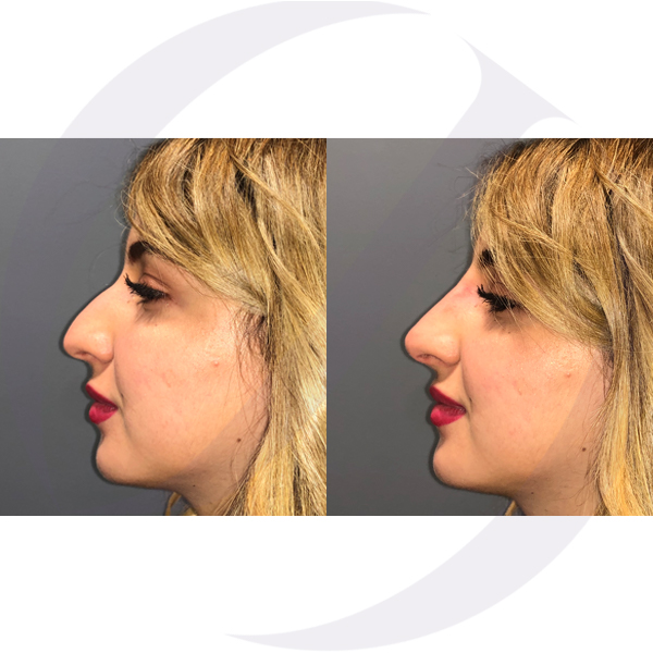 Dr_OscarJunco's tweet photo. La rinoplastia sin cirugía o rinomodelación es un tratamiento mediante el cual podemos cambiar la forma de la #nariz en menos de 10 min, sin pasar por #quirófano y sin ningún tipo de anestesia #drjunco #rinomodelacion #medicinaestetica https://t.co/lzDbuzgcik