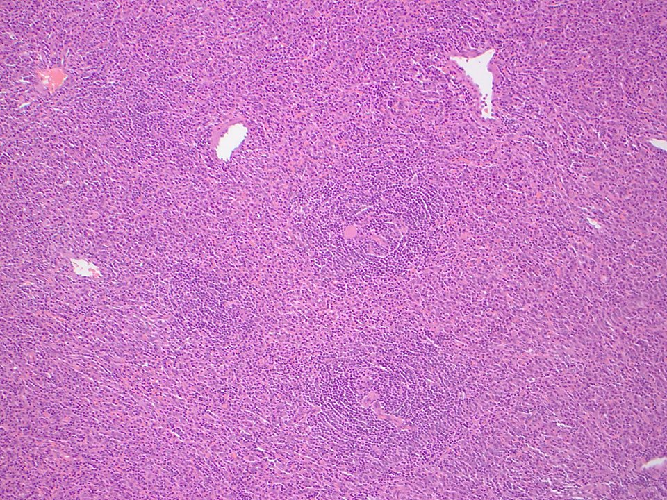 SibaElHussein's tweet image. Unicentric Castleman disease-plasma cell variant:Preserved overall lymph node architecture and marked plasmacytosis in interfollicular areas,with a subset germinal centers showing regressive changes reminiscent of Castleman disease-hyaline vascular variant #Hemepath #HemepathMDA