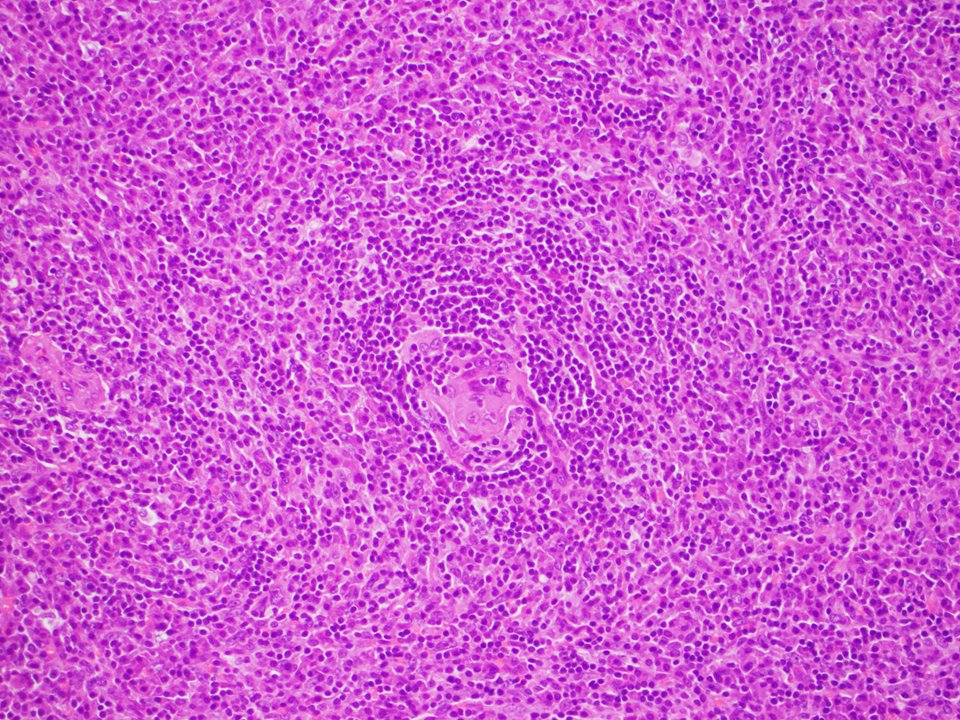 SibaElHussein's tweet image. Unicentric Castleman disease-plasma cell variant:Preserved overall lymph node architecture and marked plasmacytosis in interfollicular areas,with a subset germinal centers showing regressive changes reminiscent of Castleman disease-hyaline vascular variant #Hemepath #HemepathMDA
