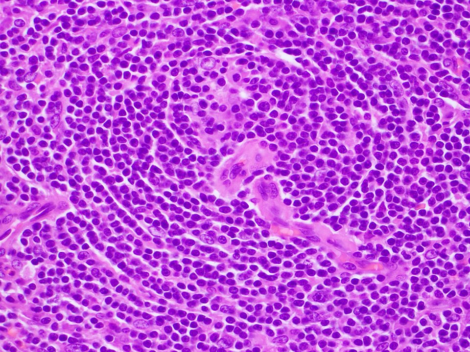 SibaElHussein's tweet image. Unicentric Castleman disease-plasma cell variant:Preserved overall lymph node architecture and marked plasmacytosis in interfollicular areas,with a subset germinal centers showing regressive changes reminiscent of Castleman disease-hyaline vascular variant #Hemepath #HemepathMDA