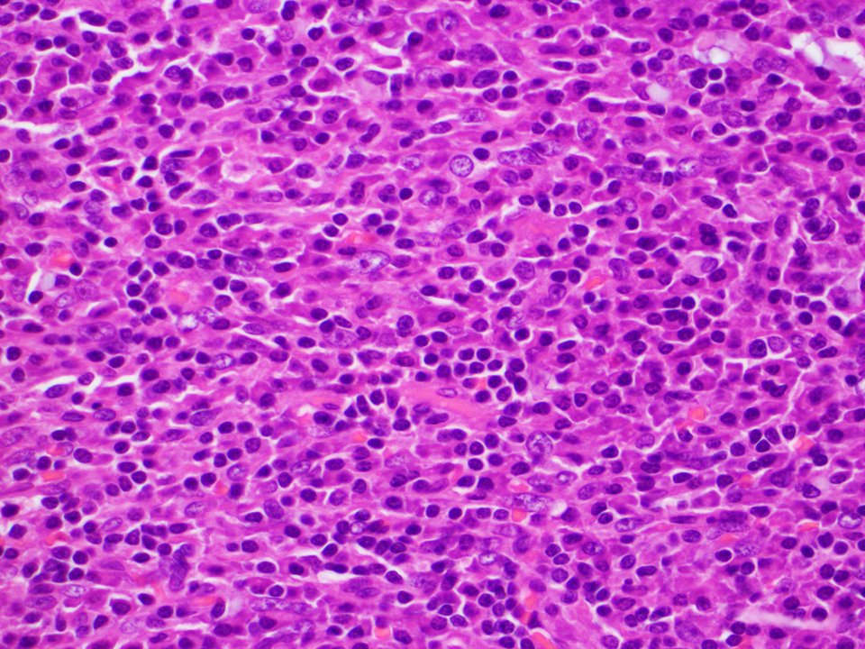 SibaElHussein's tweet image. Unicentric Castleman disease-plasma cell variant:Preserved overall lymph node architecture and marked plasmacytosis in interfollicular areas,with a subset germinal centers showing regressive changes reminiscent of Castleman disease-hyaline vascular variant #Hemepath #HemepathMDA