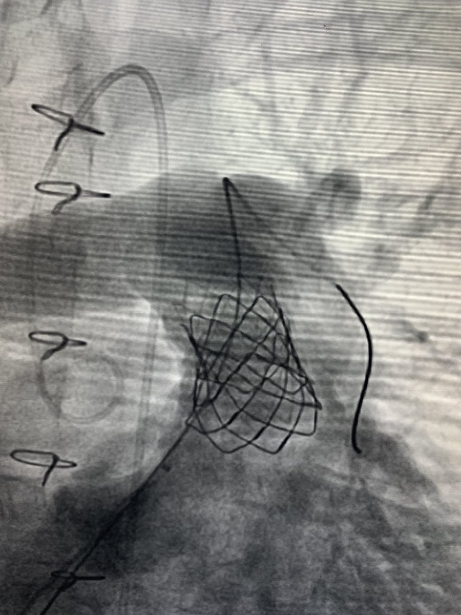 drmomani's tweet photo. Thankful for a great &amp; productive year (2019). Finished my #SHD training with leaders in the field @MidAmericaHeart to join another robust #SHD team @UTHealthSAValve #TAVR #MitraClip #TMVR #VinV #BVF #MelodyValve #ASD #PFO #HOCM and more @UTHealthSA @UnivHealthSys @SouthTexasMed https://t.co/3Jvl7eFc5q