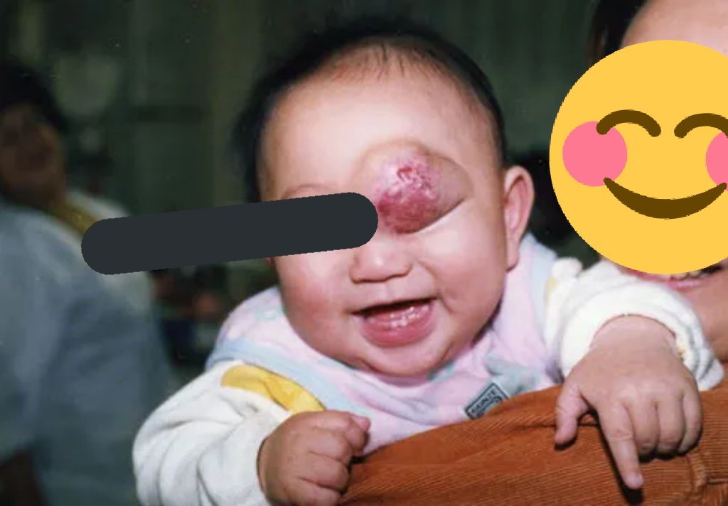 たちこ على تويتر 長男くんはまぶたに苺状血管腫と海綿状血管腫が二重にできるという事があったため視神経にもそれが絡まり 傷つき 片目を失いました いつも笑顔で人見知りもなく可愛い赤ちゃんでした 今も可愛いけど この春 社会人になります 血管腫 たちこ على تويتر 長男くんはまぶたに苺状血管腫と海綿状血管腫が二重にできるという事があったため視神経にもそれが絡まり 傷つき 片目を失いました いつも笑顔で人見知りもなく可愛い赤ちゃんでした 今も可愛いけど この春 社会人になります 血管腫