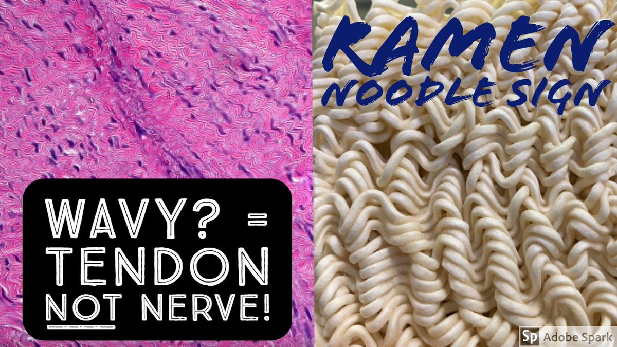 Jerad Gardner, MD (@jmgardnermd) on Twitter photo Ramen Noodle Sign of <a href="/EHFultonMD/">Edward Fulton, MD</a>. Wavy spindle cells & collagen (like instant ramen) = tendon/fascia (dense regular connective tissue) or fibroblast/myofibroblast NOT nerve or neural tumor (contrary to conventional #pathology wisdom!). My video explains: buff.ly/2tuJSPi Ramen Noodle Sign of <a href="/EHFultonMD/">Edward Fulton, MD</a>. Wavy spindle cells & collagen (like instant ramen) = tendon/fascia (dense regular connective tissue) or fibroblast/myofibroblast NOT nerve or neural tumor (contrary to conventional #pathology wisdom!). My video explains: buff.ly/2tuJSPi
