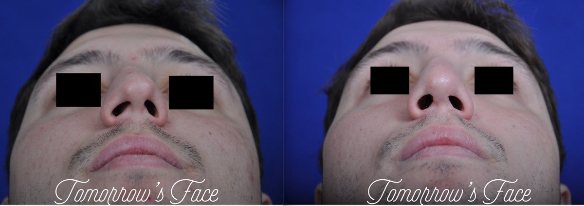 TomorrowsFace's tweet photo. Youβll be #BreathingEasier knowing Dr. Morrow will be performing your #Rhinoplasty. With over 30 years of experience, #DrMorrow is double #BoardCertified in #FacialPlasticSurgery and #Otolaryngology as well as #ENT. Call 973-243-1823 for an appointment today! https://t.co/SeJvHFvMPG