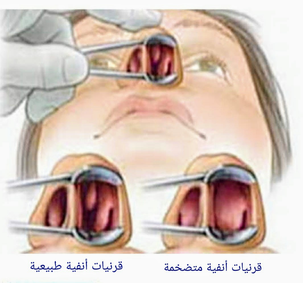 د سعد الصالح S Alsaleh Md Frcsc A Twitter ما هي القرنيات الأنفية وما هي وظائفها هي ثلاث او أربع نتوءات في الجدار الجانبي للأنف وأهمها السفلى تتحكم في درجة حرارة وكمية