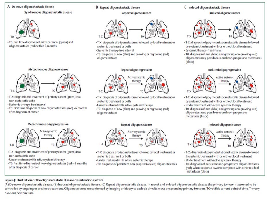 TheLancetOncol's tweet image. Review: Characterisation &amp;amp; classification of #oligometastatic disease: a @ESTRO_RT and @EORTC consensus recommendation thelancet.com/journals/lanon…