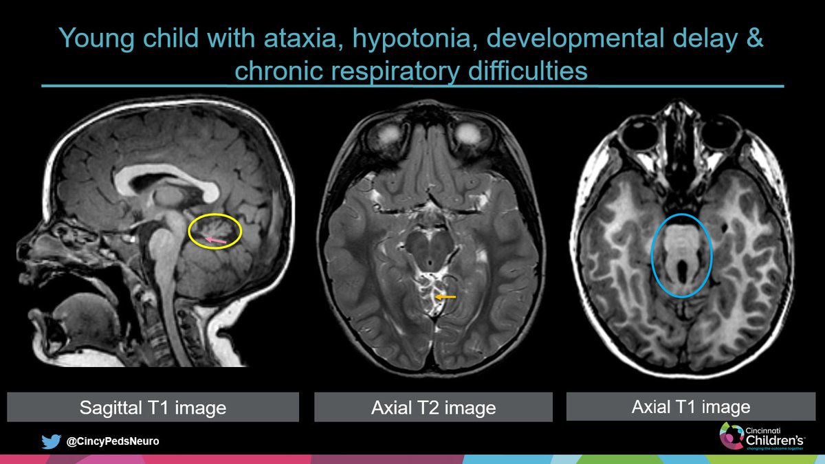 WmOBrienDO's tweet photo. #PediNeuroRad
Case for the Weekend

Slide 1: History &amp; images at presentation
Slide 2: Annotated images
Slide 3: Answer &amp; key points

Have a great weekend and hope to see/meet some of you at #ASPNR20 in Miami next weekend!

#PedsRad #NeuroRad #RadRes #FOAMrad https://t.co/1GL8MPXDZk