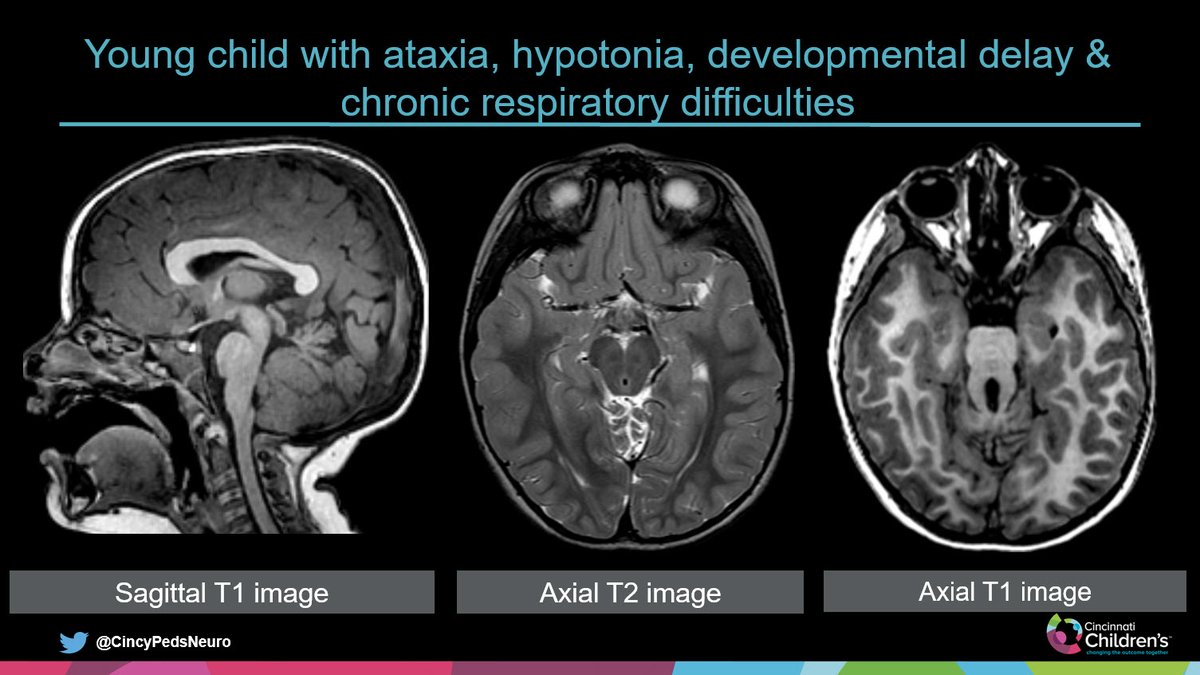 WmOBrienDO's tweet photo. #PediNeuroRad
Case for the Weekend

Slide 1: History &amp; images at presentation
Slide 2: Annotated images
Slide 3: Answer &amp; key points

Have a great weekend and hope to see/meet some of you at #ASPNR20 in Miami next weekend!

#PedsRad #NeuroRad #RadRes #FOAMrad https://t.co/1GL8MPXDZk