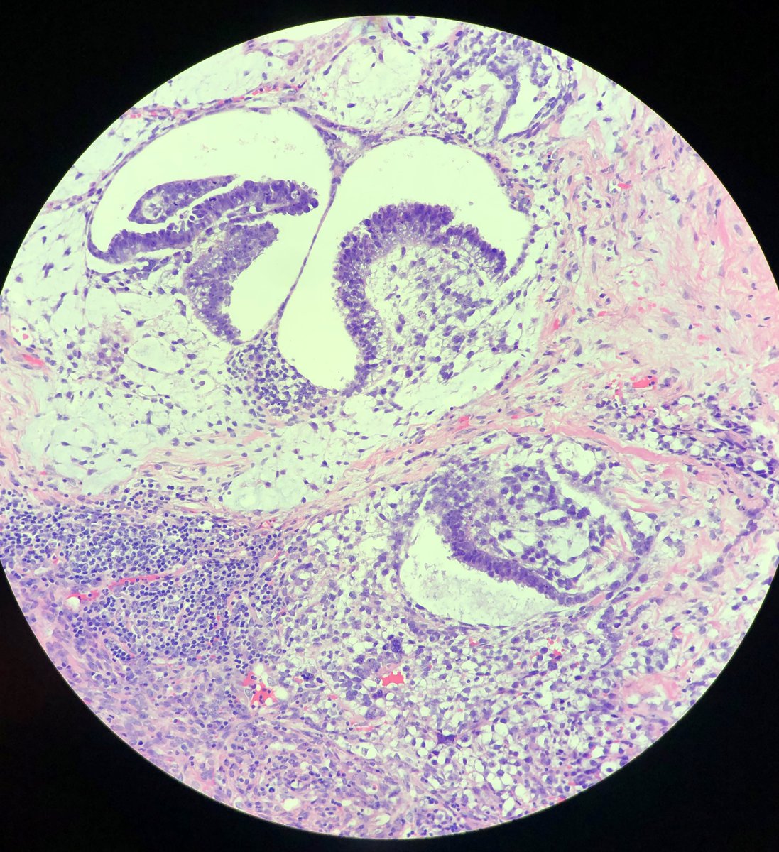 UTSW_GUPath's tweet photo. Polyembryoma
Mixed germ cell tumor showing embryoid bodies with a central plate of embryonal carcinoma cells, a dorsal cavity, and a ventral yolk sac tumor. https://t.co/P2ePOKGaOj