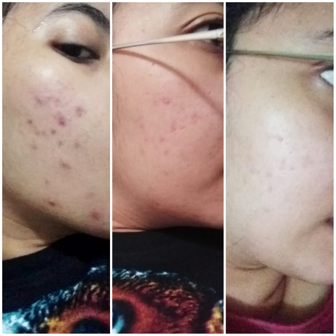 Meljulid98's tweet photo. Awal Mei-November-Januari
Cuma butuh 2 Botol!! Gak ada efek samping, ga ketergantungan, ga harus tiap hari pake!!
Ada yg butuh Threadnya??
#skincare #skinker #budgetmahasiswa #jerawat https://t.co/G41oeh3gKu