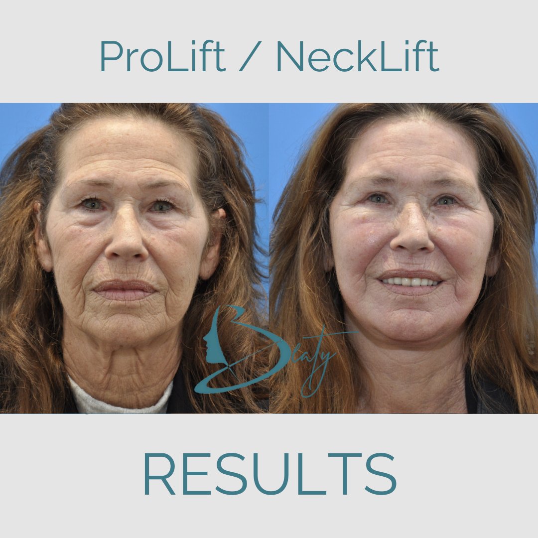 She didn't like her neck.  But, now she does!  

#beforeandafter #greatresults #plasticsurgeryatlanta  #lookyourbest