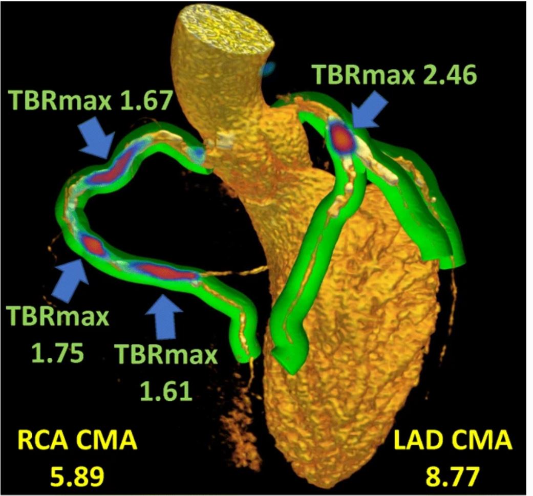 3-dimensional rendering of coronary CT angiography with superimposed whole-vessel volumes (green) employed for evaluation of 18F-sodium fluoride uptake (blue and red). Kwiecinski J, Cadet S, Daghem M et al. Eur J Nucl Med Mol Imaging (2020) link.springer.com/article/10.100…