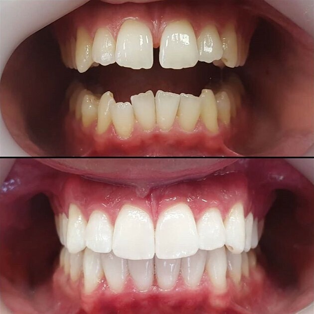 GeoNuvola's tweet photo. ✔️Invisibly working
for you!
align your teeth discretely with Nuvola aligner.
#forme#aligner#teeth#appliances#transparent#dentist#geonuvola#greatsmile#newsmile#nowires# https://t.co/igVCa6r23P https://t.co/pJyuhu1AbL