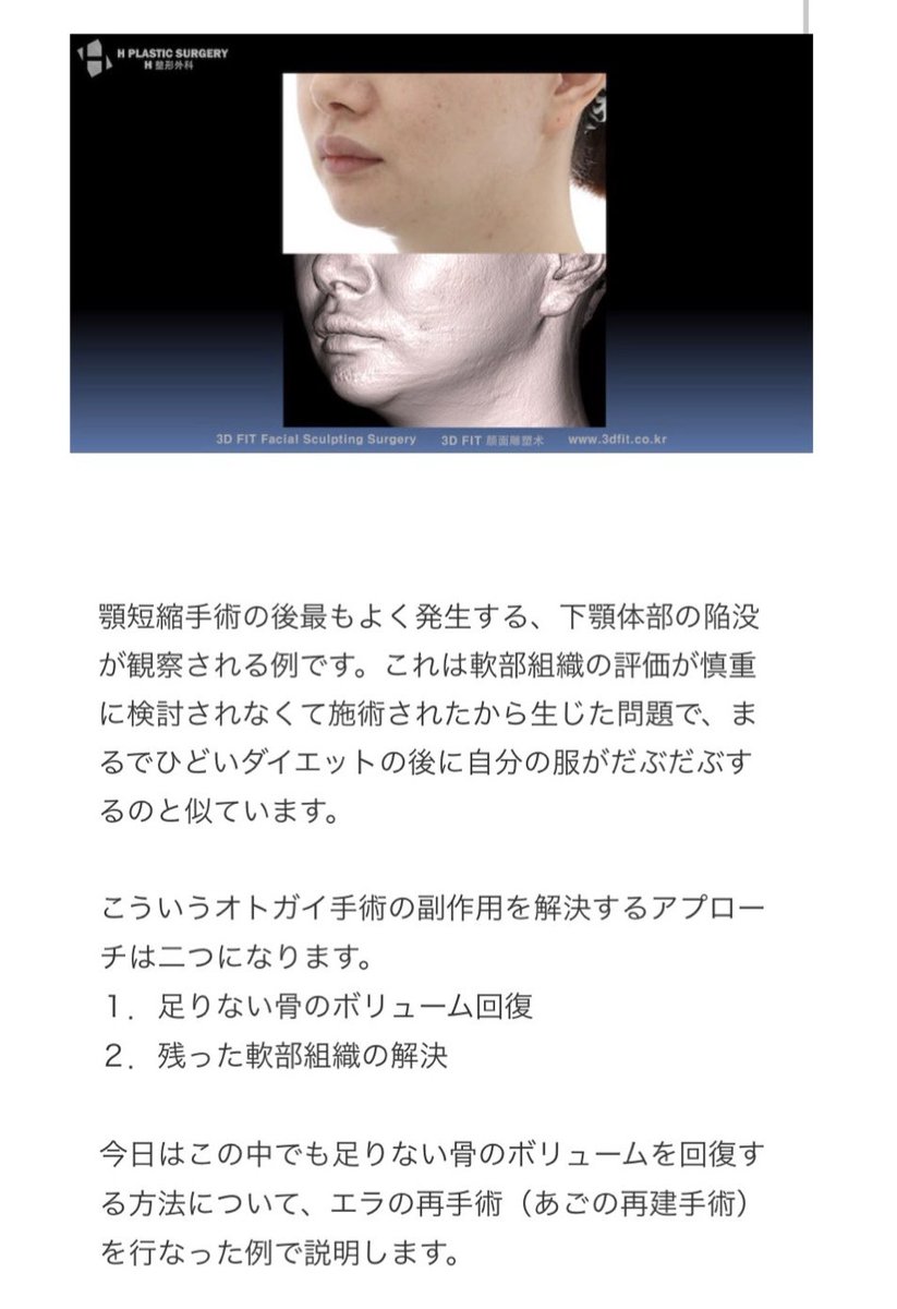 オトガイ手術、顎短縮手術は軟部組織の評価が重要。小顔になるために骨の形は完璧に施行されても軟部組織の変化でがっかりする場合も。よくある症状は下顎体部の陥没。これは軟部組織の評価が慎重にされず、余った軟部組織がダブついた結果。症例は足りない骨の再建で綺麗なフェイスライン が復活した https://t.co/8jSEhDvXBp
