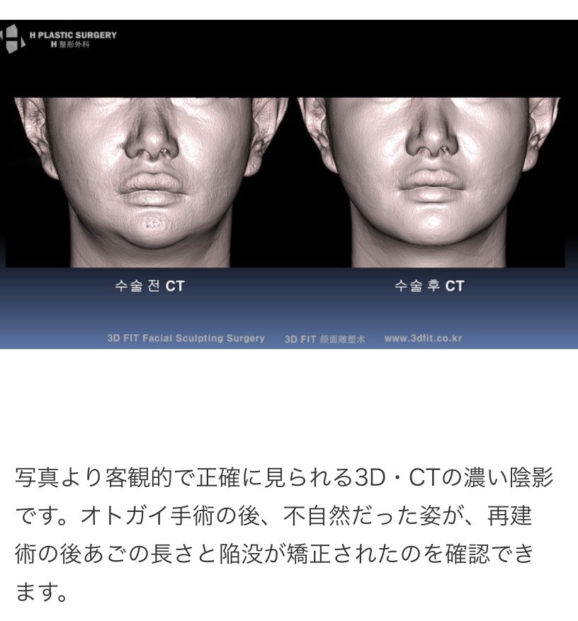 オトガイ手術、顎短縮手術は軟部組織の評価が重要。小顔になるために骨の形は完璧に施行されても軟部組織の変化でがっかりする場合も。よくある症状は下顎体部の陥没。これは軟部組織の評価が慎重にされず、余った軟部組織がダブついた結果。症例は足りない骨の再建で綺麗なフェイスライン が復活した https://t.co/8jSEhDvXBp