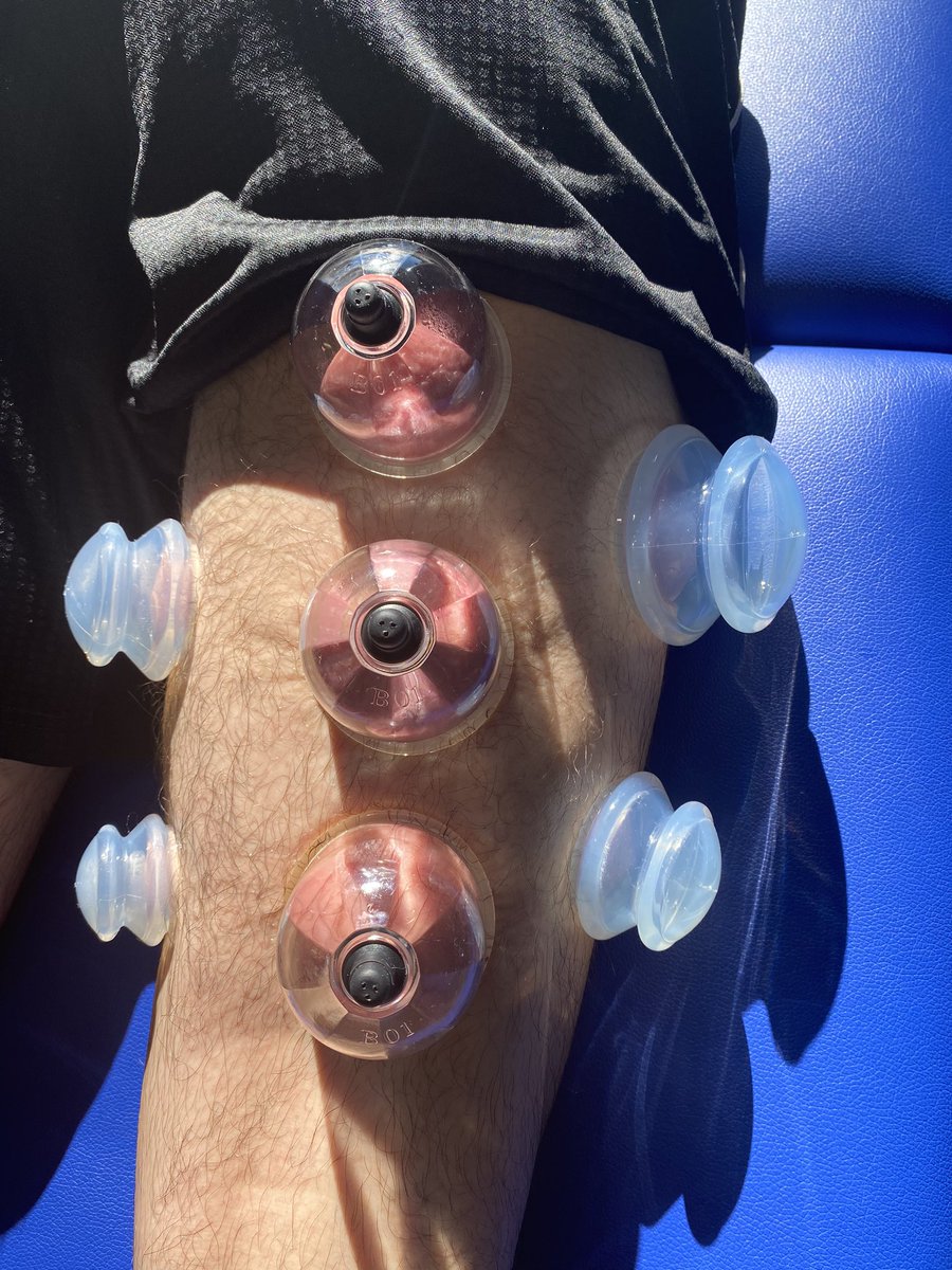 EAthletix's tweet photo. Acl Recovery With Cole Carpenter (Hancock). Emphasizing The Medial Hamstring (ROM), IT Band. #CuppingTherapy #CuppingWarehouse
#EliteTherapy @CuppingWarehous https://t.co/2CIxs17cyc