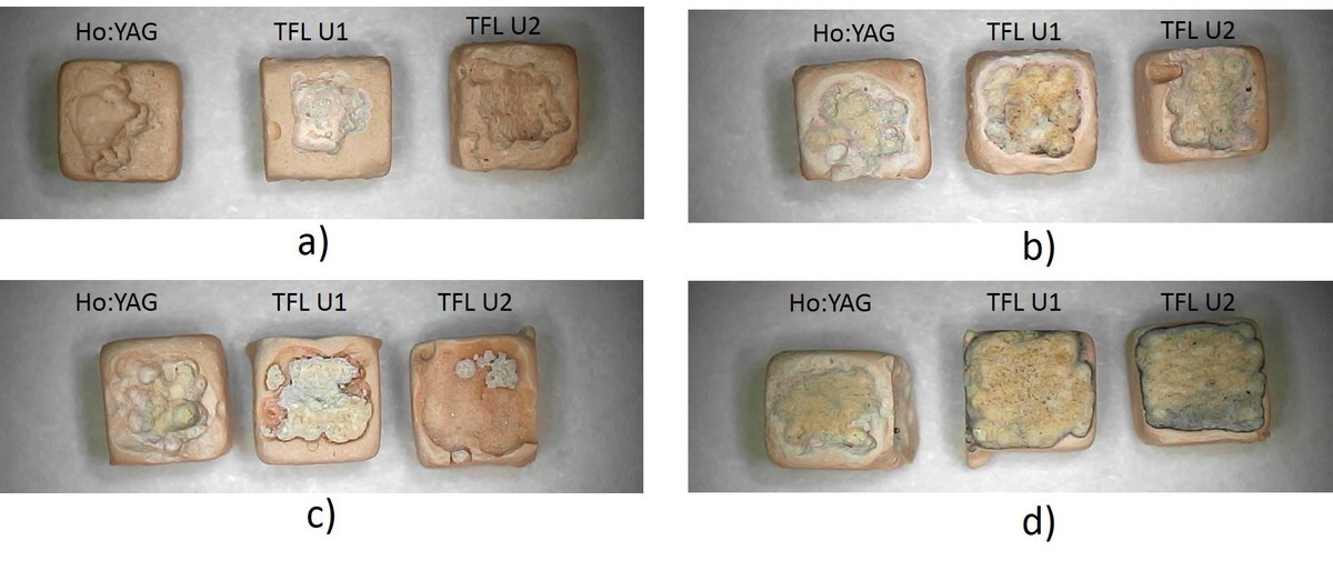 marktaratkin's tweet photo. Why and how lasers ablate stones? Why some of them are more effective than the others? Going into the depth of stone ablation mechanisms with novel Superpulse TFL and Ho:YAG #laser_tech_lab @SechenovUni @eulis_uroweb @eauesut https://t.co/ymoMyKI8AU https://t.co/UyHEOlL08N