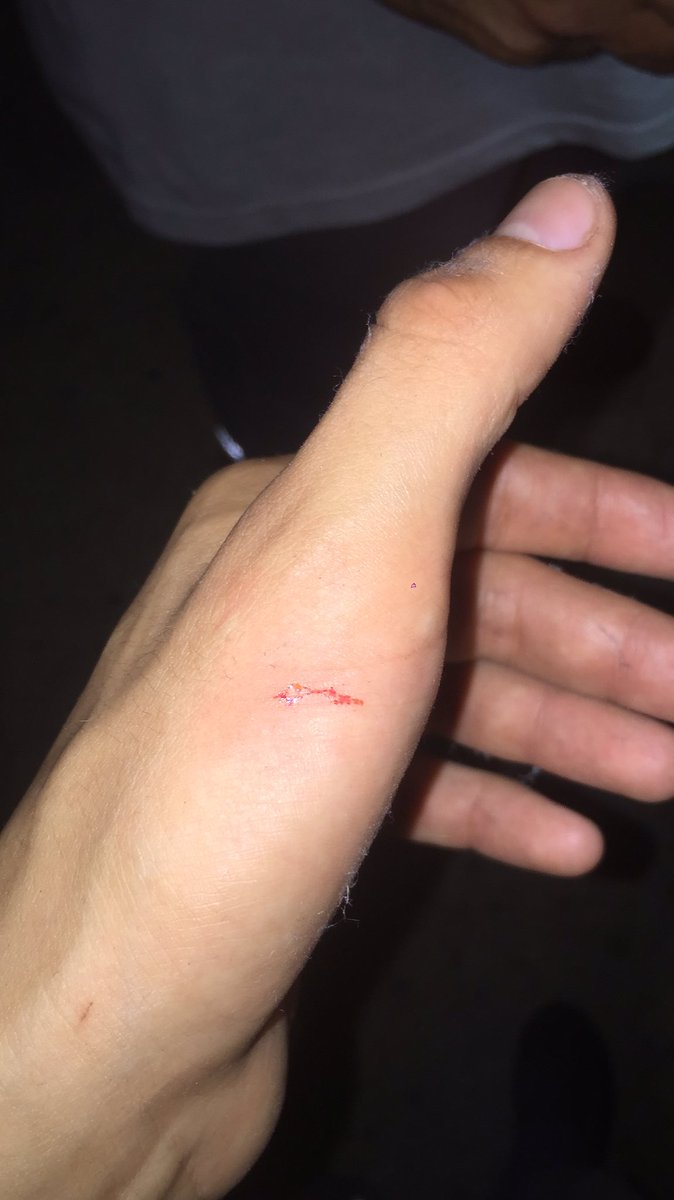 JaviLeguizamon9's tweet image. Sean conscientes de que estas cosas se tiran dentro de una botella o una caja, los recolectores tenemos familia también y queremos llegar bien a nuestras casas, por suerte no tengo nada y puedo hacer un tratamiento durante un tiempo y listo, pero sean conscientes de lo que tiran.