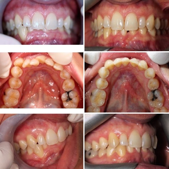 GeoNuvola's tweet photo. The power of Nuvola aligner System!  Combining innovative Italian design with attentive technical support and dependable service to create a compelling new brand of aligners for British dental professionals.

The Nuvola system features:
NuvolaWEB online … https://t.co/K3c7Y2bXLp https://t.co/jLsyb5y4Uw