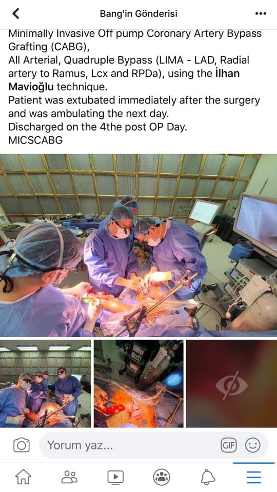 TRKRAHMET's tweet photo. 2 ay önce İrmet Hospital’da eğitim alan Filipinli kalp-damar cerrahları, ülkelerine döndükten sonra İlhan hocamızın tekniğini uygulayarak arteryel greft ile 4 damar atan kalpte meme altı küçük kesi bypass yapmış ve sevinçlerini sosyal medyada paylaşmışlar.
#MIDCAB #MICSCABG https://t.co/wUO7x2SHum