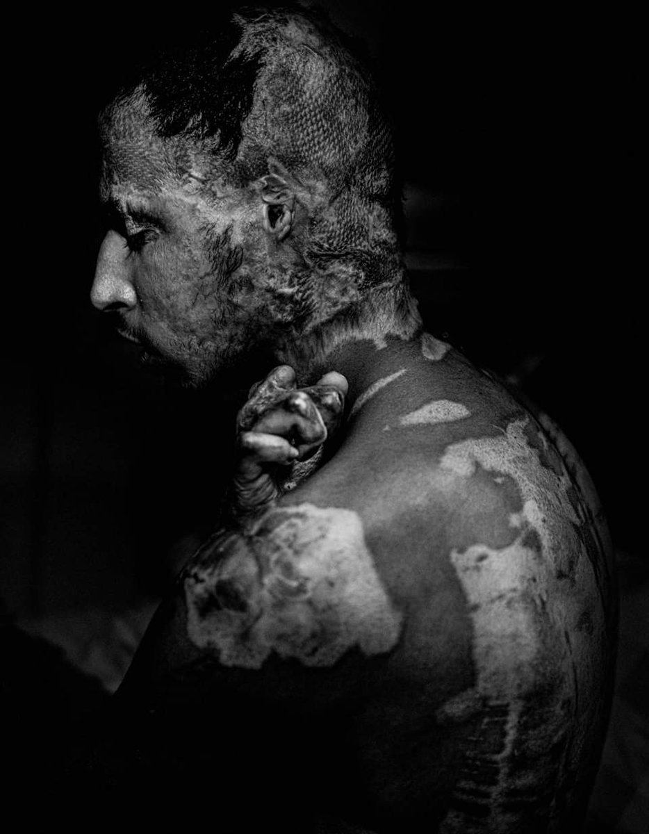 NewsBalkanRoute's tweet photo. "Ahmad left his country to pursue a better life in Europe. While in #Bosnia, his friend got killed in a fight, Ahmad was arrested and in desperation he tried to burn himself in sorrow and to protest his arrest. Now he is stuck in Bihac"
📸 Jan Grarup
https://t.co/I3NNXYoGE6 https://t.co/U1LWIEKfnz