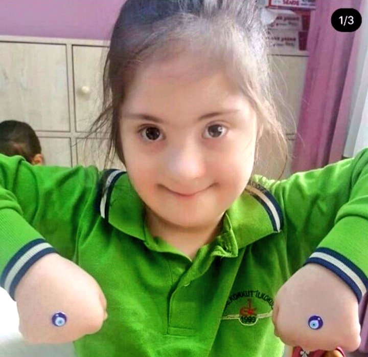 MMustafaSaritas's tweet photo. 7 yaşındaki down sendromlu bu sevimli kızın annesi Nuran Dilber tutuklanmış. Bu yaşta down sendromlu bakıma muhtaç bir çocuğu annesinden ve şefkatinden mahrum bırakmak insanlığa sığmaz! 

Adalet dilenmiyoruz zira ülkeyi terk edeli çok oldu. Bari insaf vicdan!

DownSendromlu Nalan https://t.co/Fms8sOQULb