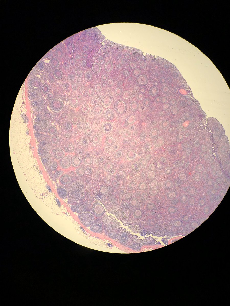 DCSkipperDO's tweet photo. Young female, retroperitoneal adenopathy, concern was for malignancy. I thought I would never see cases like this again outside academics. Good thing I paid attention during #hemepath lectures!  Dx?  Some 🦓 pathology in the Carolinas @Chucktowndoc #pathology #surgpath https://t.co/SlzBk1fm3J