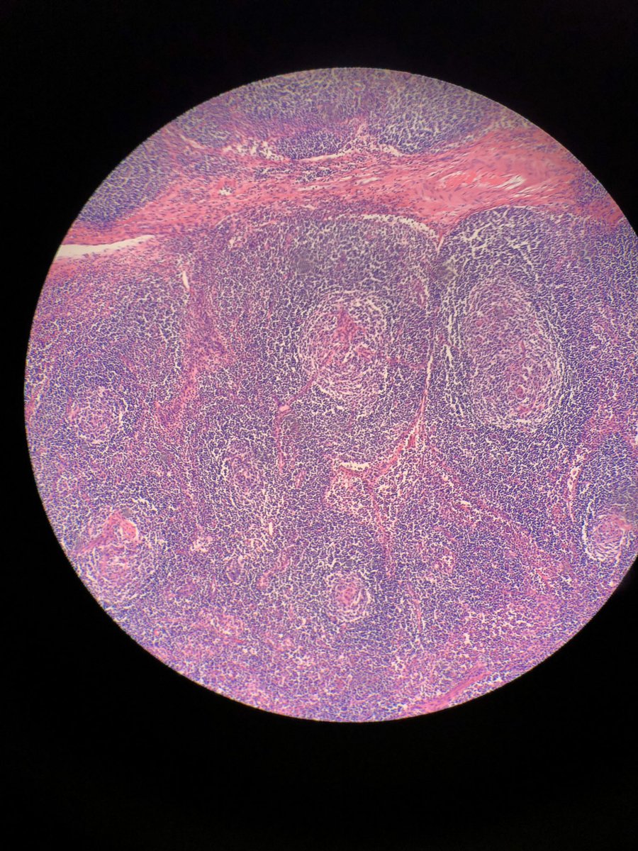 DCSkipperDO's tweet photo. Young female, retroperitoneal adenopathy, concern was for malignancy. I thought I would never see cases like this again outside academics. Good thing I paid attention during #hemepath lectures!  Dx?  Some 🦓 pathology in the Carolinas @Chucktowndoc #pathology #surgpath https://t.co/SlzBk1fm3J