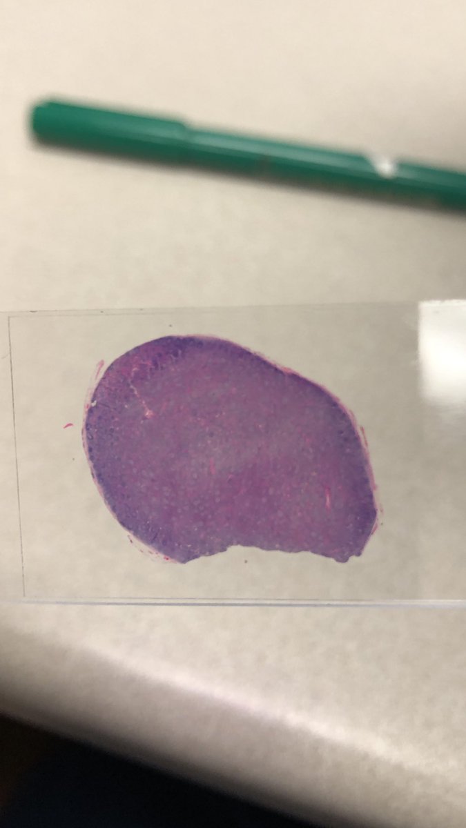DCSkipperDO's tweet photo. Young female, retroperitoneal adenopathy, concern was for malignancy. I thought I would never see cases like this again outside academics. Good thing I paid attention during #hemepath lectures!  Dx?  Some 🦓 pathology in the Carolinas @Chucktowndoc #pathology #surgpath https://t.co/SlzBk1fm3J