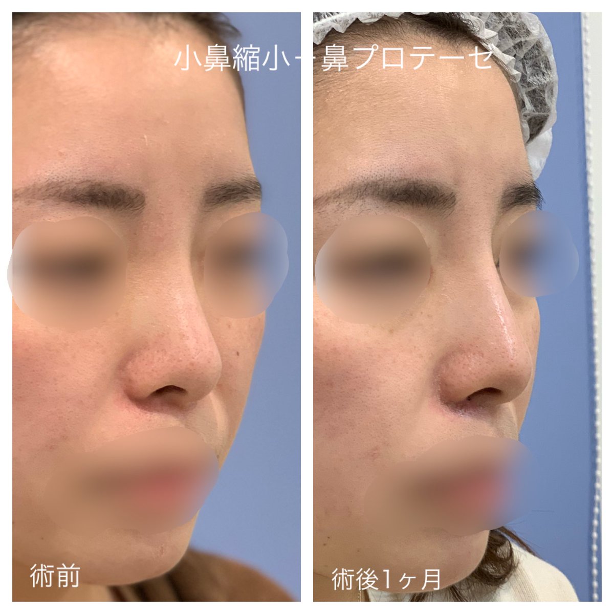 ট ইট র 湘南美容クリニック 池袋西口院院長 多田彩子 鼻プロテーゼ モニター価格円 小鼻縮小 内側法 辻堂院限定モニター 円 無料カウンセリング予約 鼻整形 美容整形 湘南美容クリニック S南 美容垢 ダイエット ট ইট র 湘南美容クリニック 池袋西口院院長 多田彩子 鼻プロテーゼ モニター価格円 小鼻縮小 内側法 辻堂院限定モニター 円 無料カウンセリング予約 鼻整形 美容整形 湘南美容クリニック S南 美容垢 ダイエット