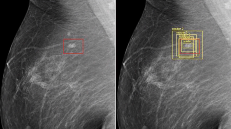 Gizmodo's tweet photo. Google's AI proves better at detecting breast cancer than doctors
https://t.co/V0pK2sTLgi https://t.co/r8cVDxF7zQ