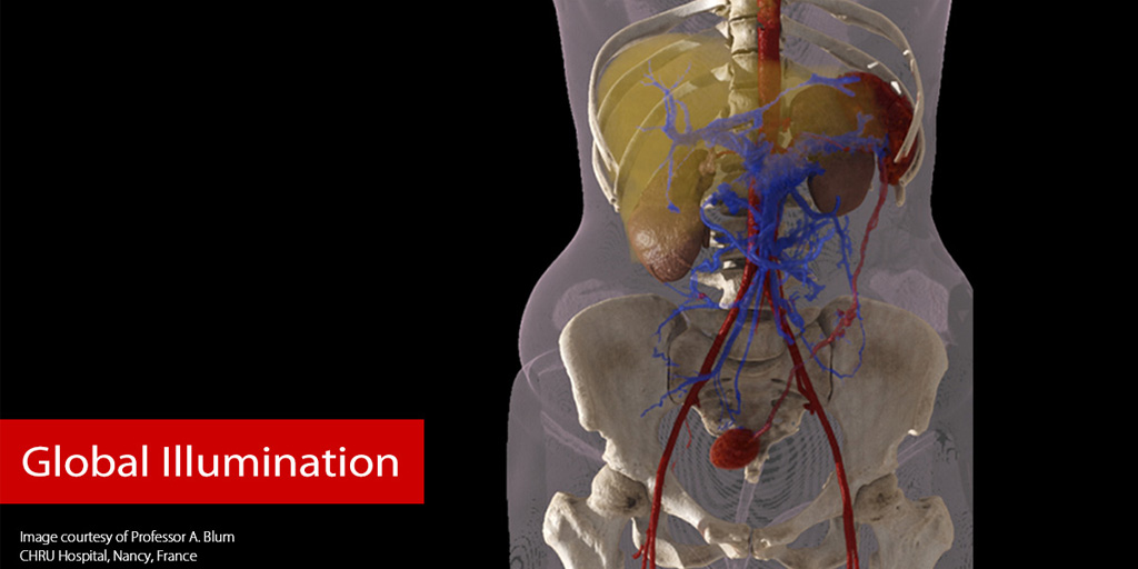 CanonMedicalEU's tweet photo. 3D imaging and stunning #photorealistic quality made it easy for physicians to visualise this patient’s wandering spleen. 
#GlobalIllumination: https://t.co/0H6Nxc0XdQ 

In picture: Wandering spleen. Easily identified with GIR in 3D.
#advancedvisualisation #volumerendering https://t.co/YMzuThWKEK
