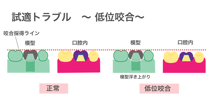 歯型の浮き上がりのtwitterイラスト検索結果