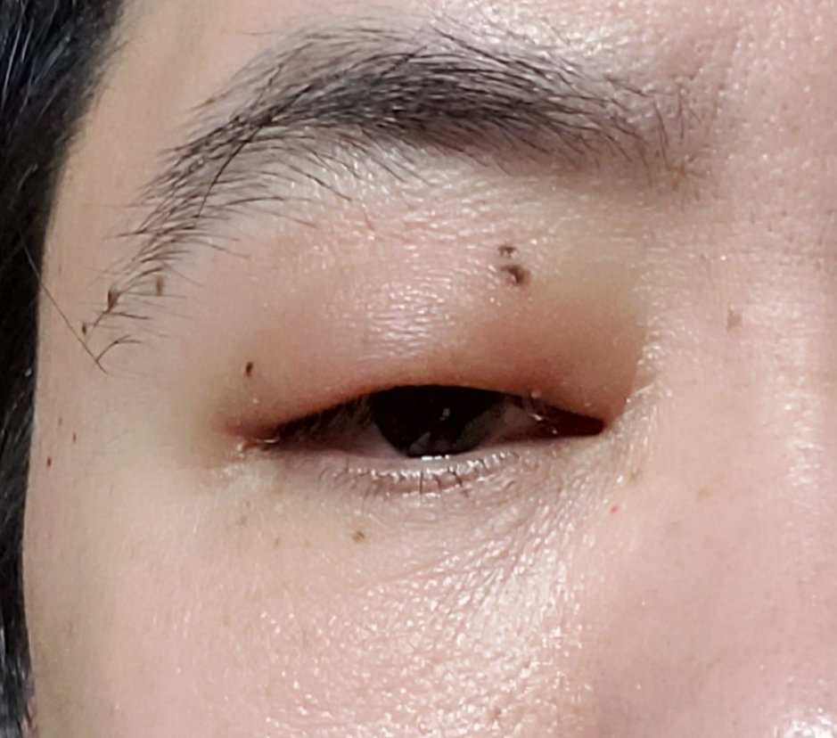 アッツ 腎臓 の影響らしい 右目 まぶた 腫れ 腎臓 T Co 67ogk1bohn Twitter アッツ 腎臓 の影響らしい 右目 まぶた 腫れ 腎臓 T Co 67ogk1bohn Twitter