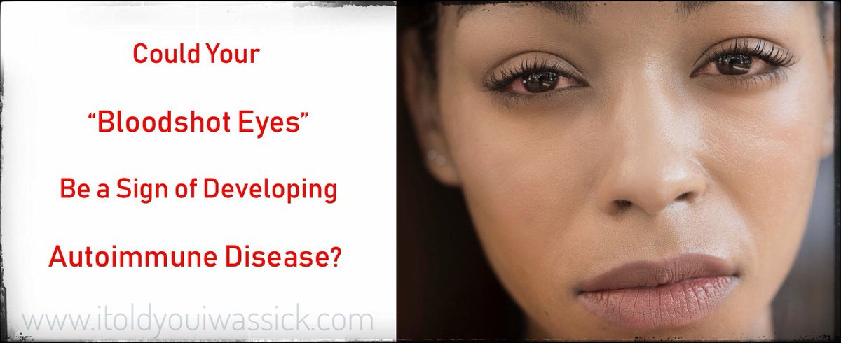 Could Your “Bloodshot Eyes” Be a Sign of Developing Autoimmune Disease?: buff.ly/2L7N9uW #bloodshoteyes #redeyes #scleritis #autoimmunedisease #mysterysymptoms #spoonie Please RT