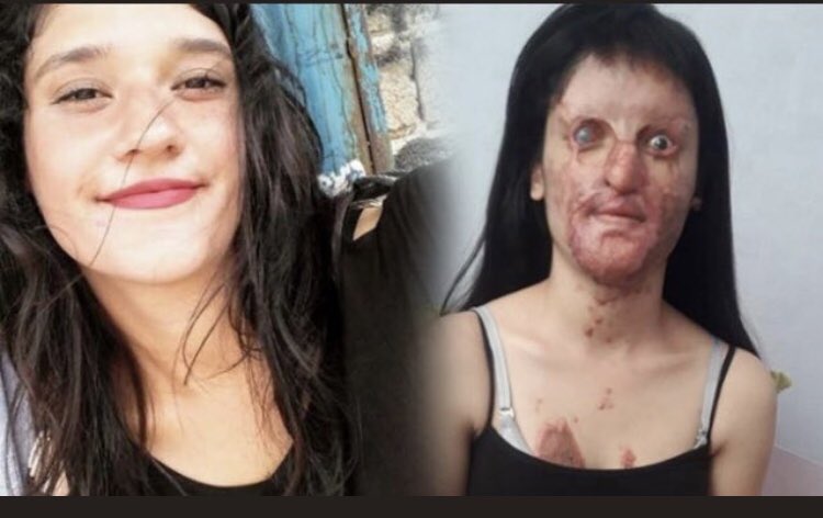 Berfin için “basit yaralama” derseniz toplumu yaralarsınız.
Elinde asit olan bir erkek bir genç kızın yüzüne planlayarak asit atıyorsa bu öldürmeye teşebbüstür.Belki ağır yaralama da diyebilirsiniz ama elinizi vicdanınıza koyun.
Bu kızı yaşarken öldürmedik mi?
#BerfinİcinAdalet