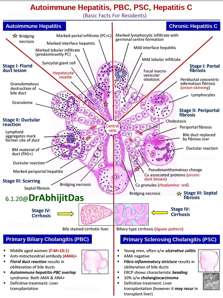 Former 'primary biliary cirrhosis' has been renamed as 'primary biliary cholangitis' since early detection with AMA screening &amp; UDCA use as first-line therapy have been found to prevent cirrhotic progression in majority of PBC patients. 

#PBCvsPSC #BasicFactsForResidents