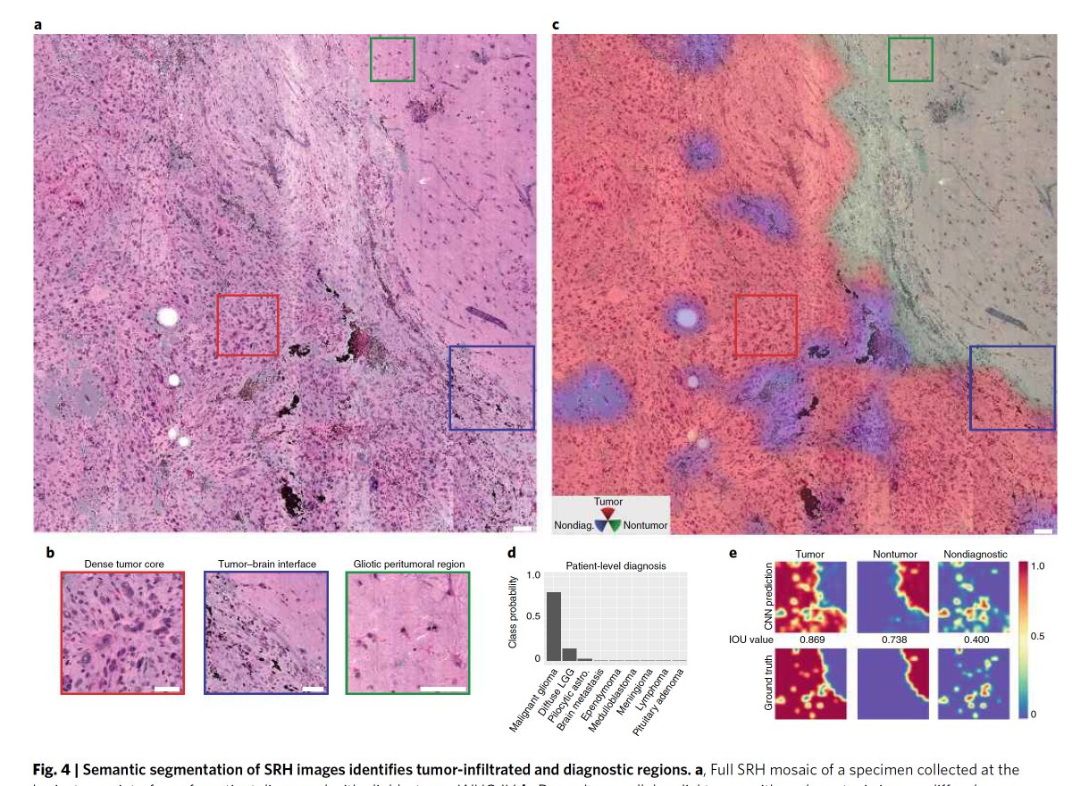 Eric Topol (@erictopol) on Twitter photo A prospective clinical trial of #AI to determine intraoperative #cancer in near real time using label-free imaging: impressive rapid, accurate results
by <a href="/umichneuro/">Michigan Neurosurgery</a> <a href="/ToddCHollon/">Todd Hollon</a> <a href="/DanOrringerMD/">Daniel Orringer</a> & collaborators <a href="/NatureMedicine/">Nature Medicine</a> nature.com/articles/s4159… A prospective clinical trial of #AI to determine intraoperative #cancer in near real time using label-free imaging: impressive rapid, accurate results
by <a href="/umichneuro/">Michigan Neurosurgery</a> <a href="/ToddCHollon/">Todd Hollon</a> <a href="/DanOrringerMD/">Daniel Orringer</a> & collaborators <a href="/NatureMedicine/">Nature Medicine</a> nature.com/articles/s4159…