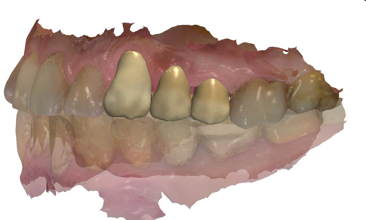 ImpChenCAD's tweet photo. Ian Dental Design Studio, if you need to outsource design dental crowns, veneers, models, implants.
contact me .WeChat：+8618318409059/email：18318409059@163.com/WhatsAPP:+8618318409059 https://t.co/mY646dRK8X