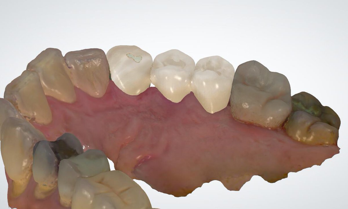 Ian Dental Design Studio, if you need to outsource design dental crowns, veneers, models, implants.
contact me .WeChat：+8618318409059/email：18318409059@163.com/WhatsAPP:+8618318409059